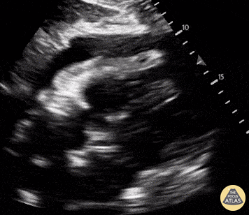 Pericardial Disease - RV Diastolic Collapse in Cardiac Tamponade