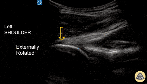 Musculoskeletal - Shoulder Subluxation