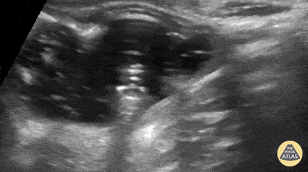 Bowel-GI - Pediatric gastrostomy replacement