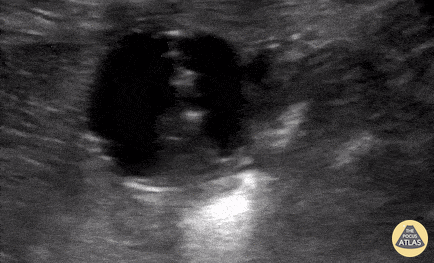 Bowel-GI - Unsuccessful pediatric gastrostomy replacement