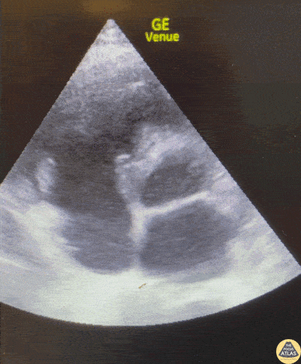 Valvulopathy - Tricuspid Valve Vegetation