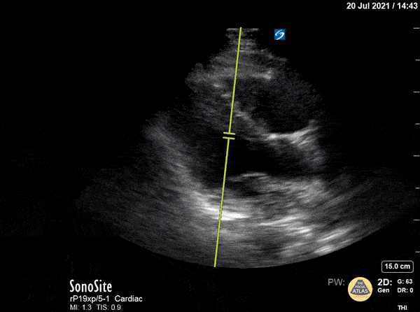 Right Ventricular Dysfunction - McConnell's Sign on PLAX View