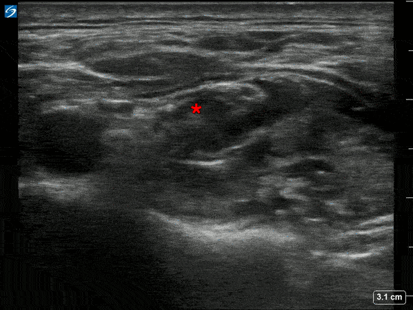 Nerve Block Gallery - Supraclavicular Nerve Block