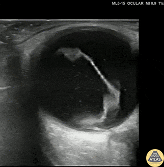Orbital - Spontaneous Retinal Detachment