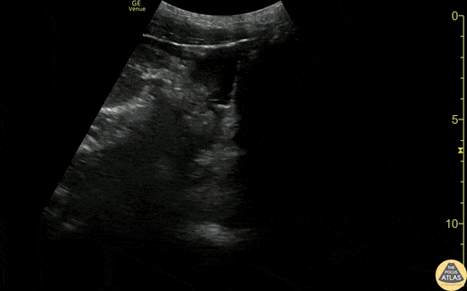 Trauma - Suprapubic +FAST from GSW