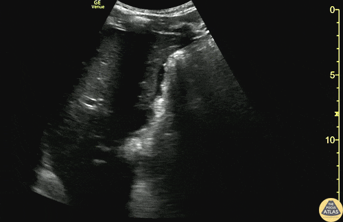 Trauma - Subtle +RUQ FAST from GSW