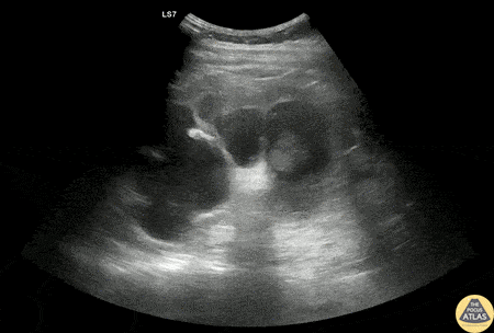 Renal/GU - Severe Hydronephrosis