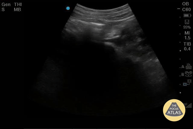 OB/Gyn - Bicornuate Uterus - Pregnant
