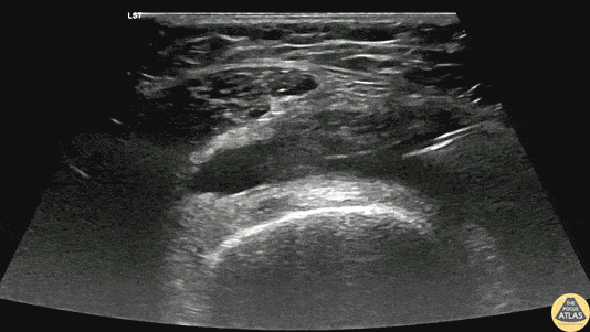 Musculoskeletal - Arthrocentesis of Knee Effusion