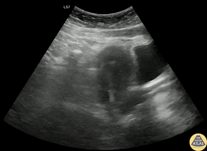 OB/Gyn - +FAST Ectopic Pregnancy with IUD