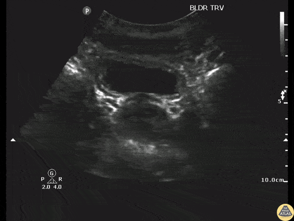 Renal/GU - UVJ Stone