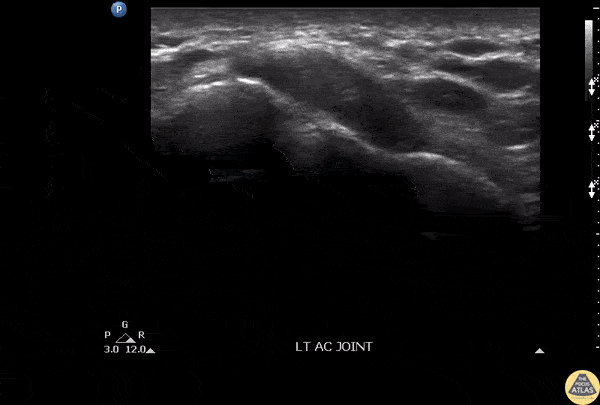 Musculoskeletal - Septic AC Joint