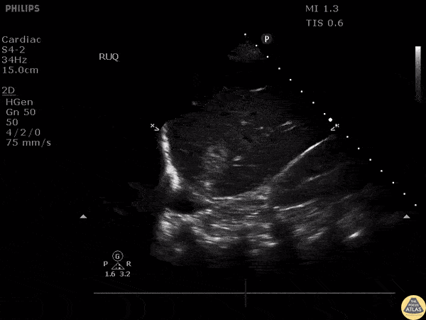 Bowel-GI - Liver Metastasis