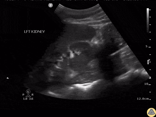 Renal/GU - Renal Abscess