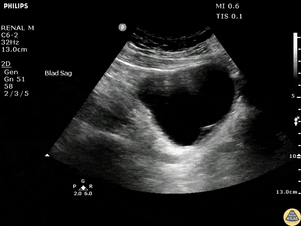 Renal/GU - Bladder Hematoma