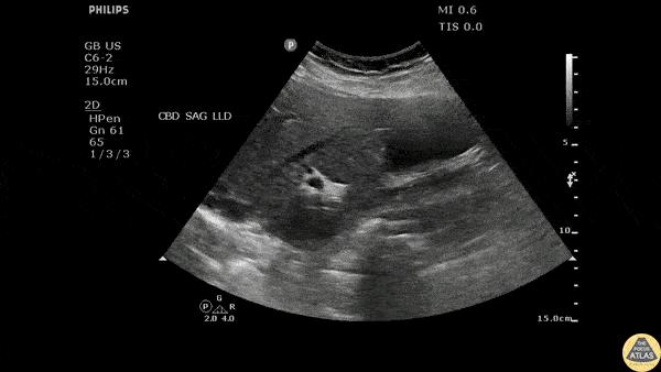 Biliary - Cholelithiasis with Adenomyomatosis