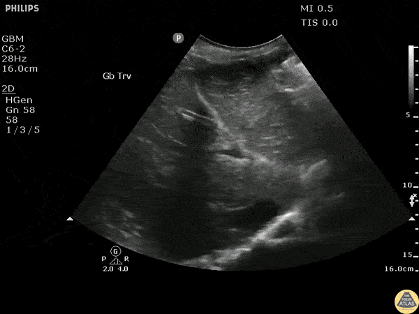 Biliary - Intrahepatic Ductal Dilation