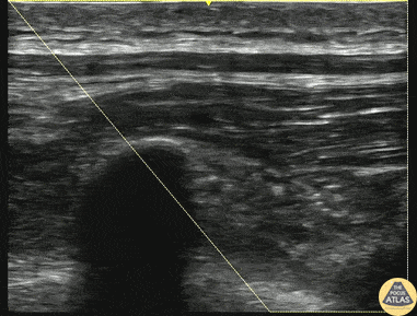 Nerve Block Gallery - Erector Spinae Plane Block