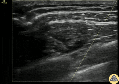 Nerve Block Gallery - Sub-Serratus Anterior Plane Block for GSW