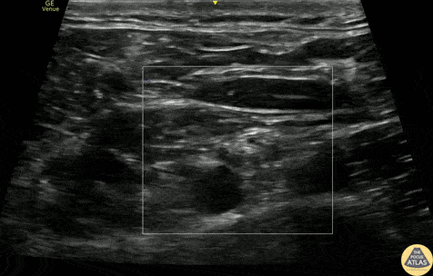 Nerve Block Gallery - Supraclavicular Brachial Plexus Block
