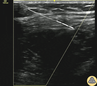 Nerve Block Gallery - Serratus Anterior Plane Block for PTX