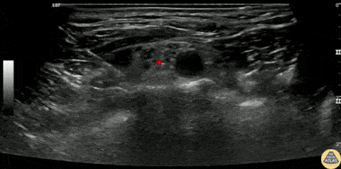 Nerve Block Gallery - Supraclavicular Nerve Block