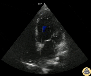 Valvulopathy - Severe Mitral Regurgitation