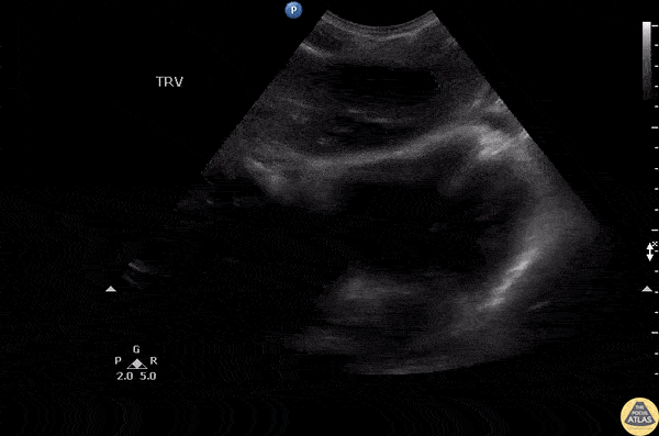 Bowel-GI - Paraesophageal Abscess