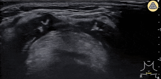 Soft Tissue - Epiglottitis