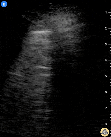 Peds-Lung - Pediatric Consolidation
