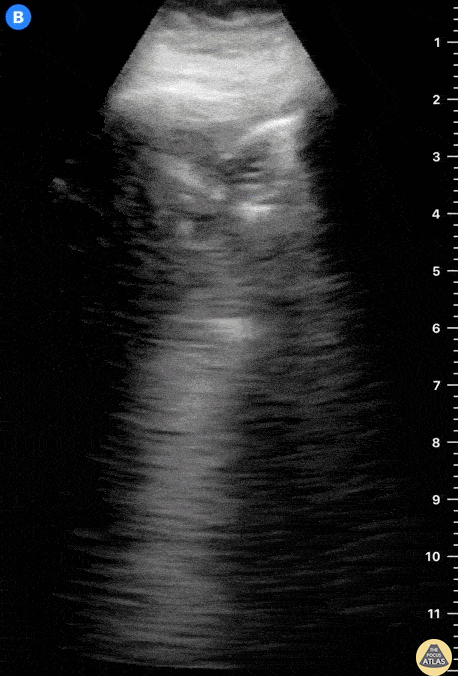 Pulmonary - Pneumonia