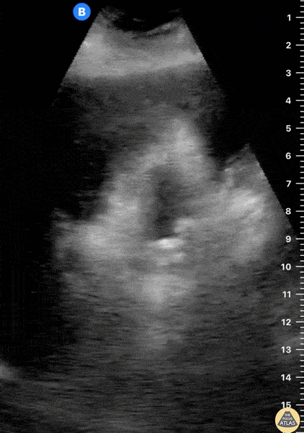 Biliary - Cholelithiasis - Multiple Stones