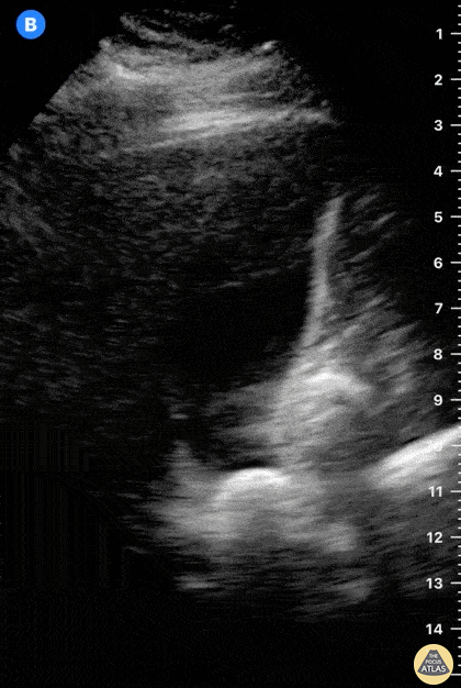 Biliary - Cholelithiasis - Impacted Stone