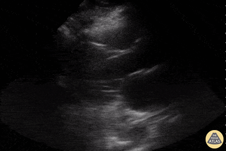 Other Cardiac Pathology - LV mass/thrombus