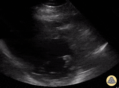 Other Cardiac Pathology - LV thrombus, parasternal short axis