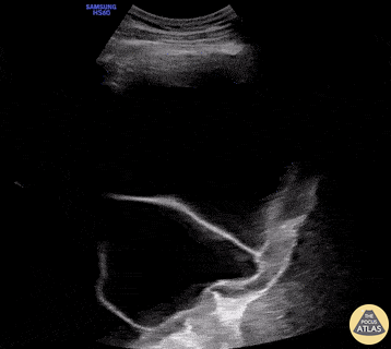 Pulmonary - Septated Pleural Effusion