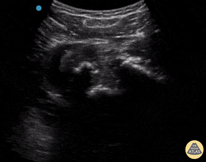 Musculoskeletal - Inferior Shoulder Dislocation