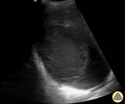 Biliary - Hepatic Abscess