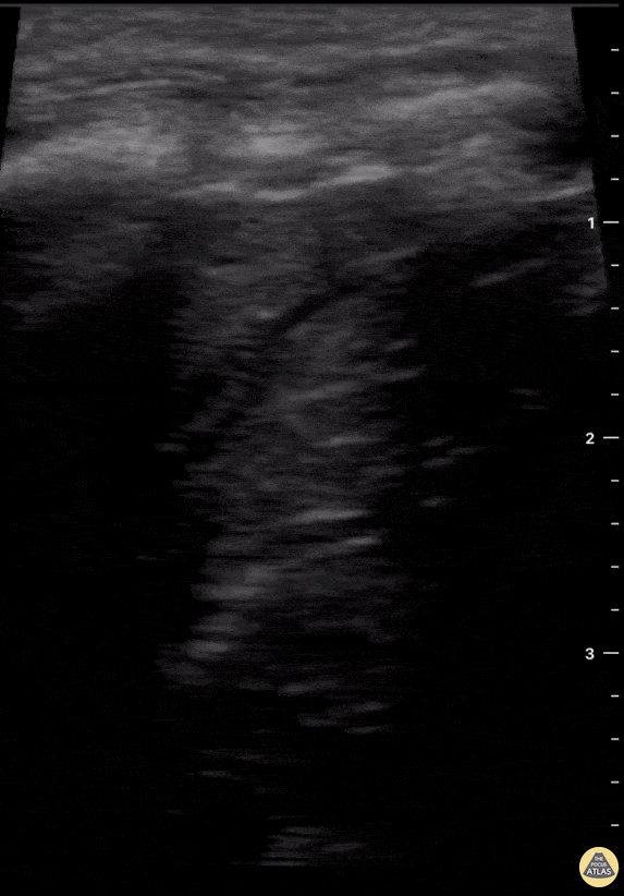 Peds-Lung - Lung Atelectasis After Foreign Body Aspiration
