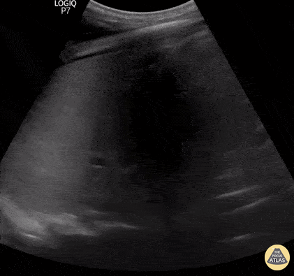 Pulmonary - PLAPS consolidation