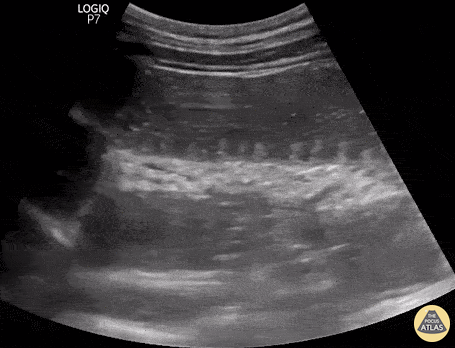 Bowel-GI - To-And-Fro of SBO