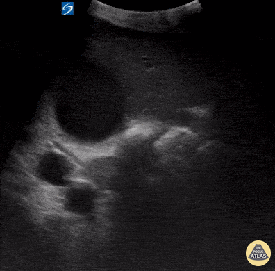 Biliary - Distended Gallbladder