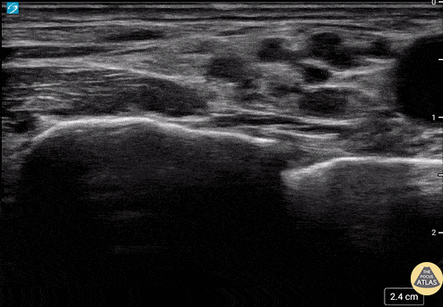 Nerve Block Gallery - Supraclavicular Brachial Plexus Anatomy