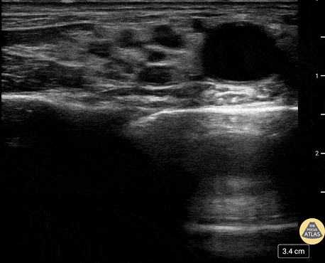 Nerve Block Gallery - Lateral femoral cutaneous nerve block