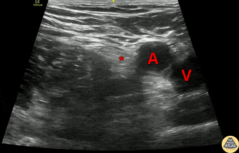 Nerve Block Gallery - Fascia Iliaca Compartment Block