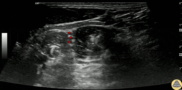 Nerve Block Gallery - Interscalene Block