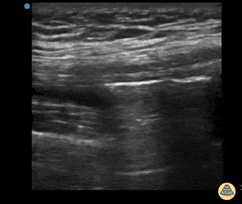 Musculoskeletal - Intra-Articular Air