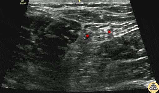 Nerve Block Gallery - Popliteal Sciatic Block