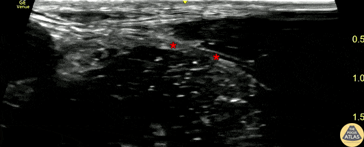 Nerve Block Gallery - Fascia Iliaca Nerve Block for GSW
