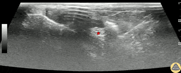 Nerve Block Gallery - Posterior Tibial Block for Frostbite